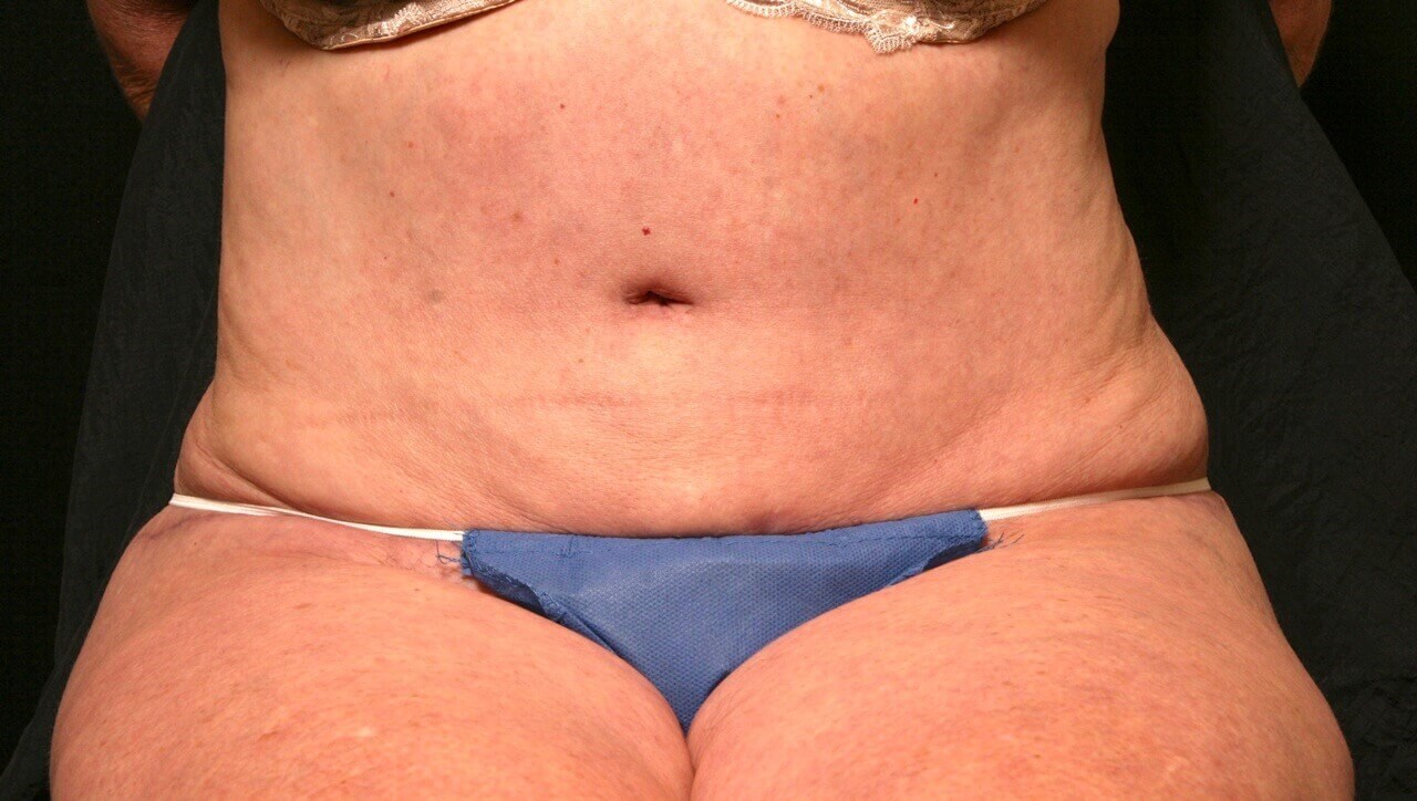 Abdominoplasty Results After