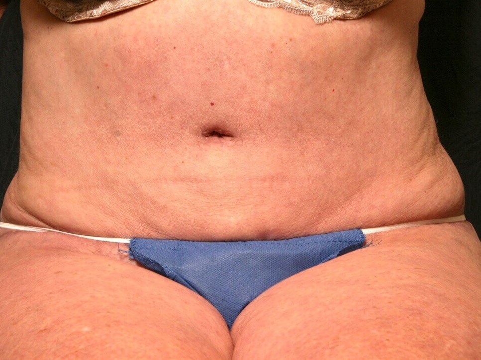 Abdominoplasty Results After