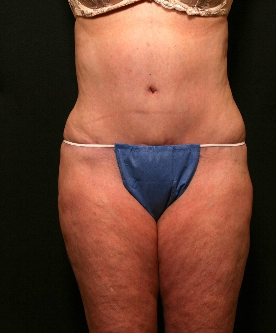 Abdominoplasty Results After