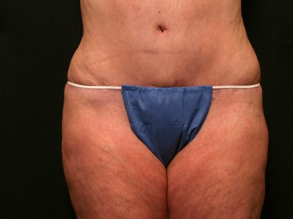 Abdominoplasty Results After