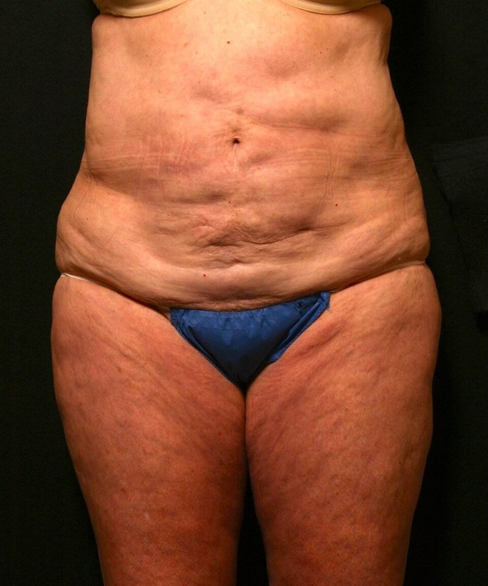 Abdominoplasty Results Before