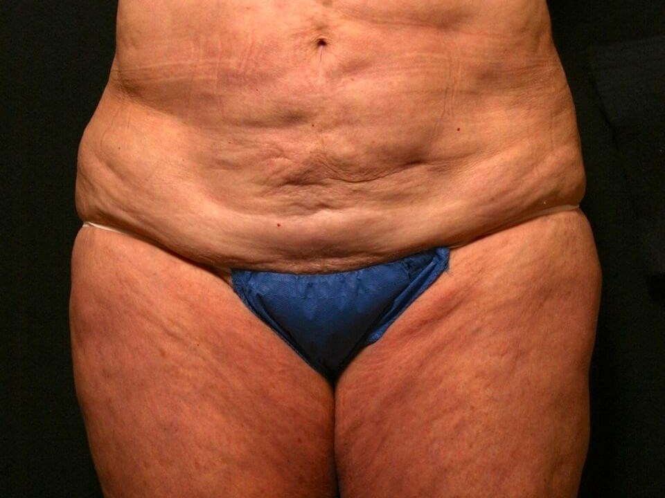 Abdominoplasty Results Before