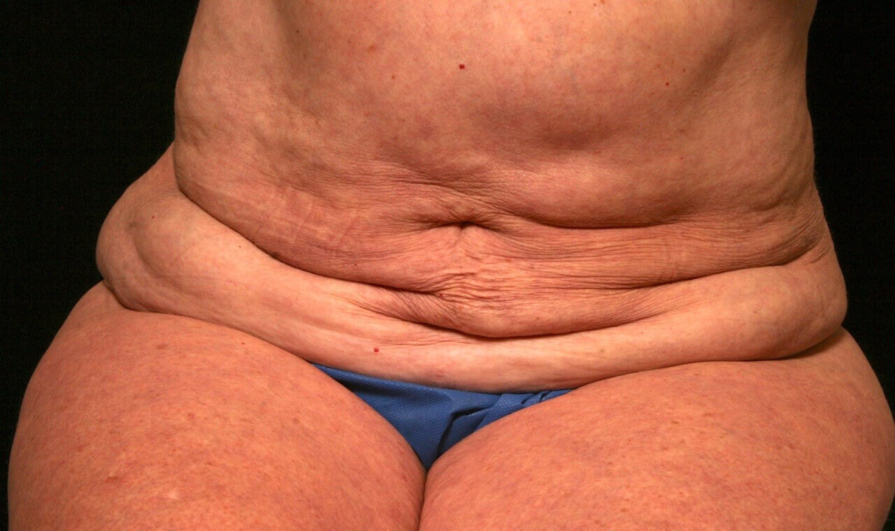 Abdominoplasty Results Before