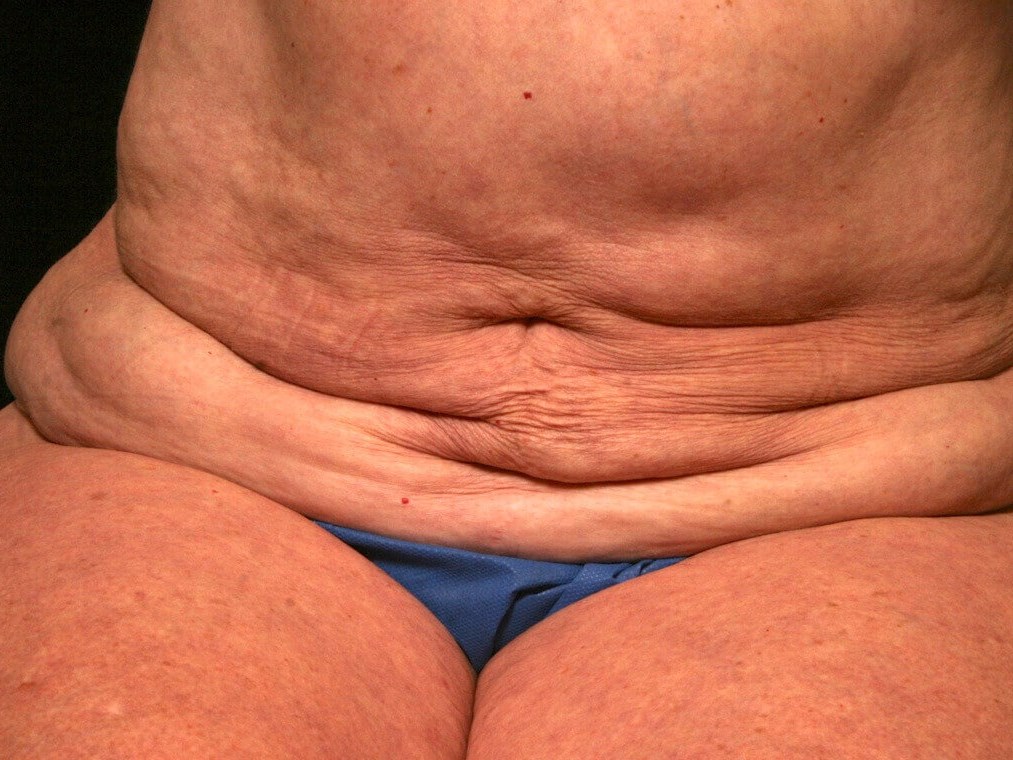 Abdominoplasty Results Before