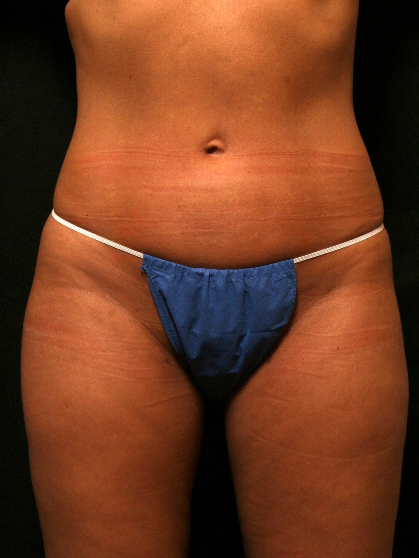 Liposuction Before and After After