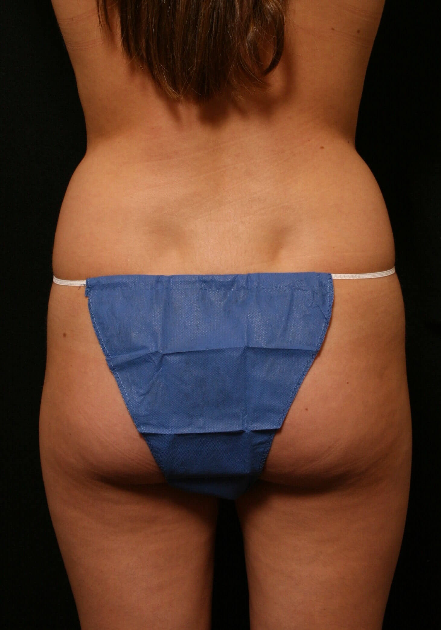 Liposuction Before and After Before
