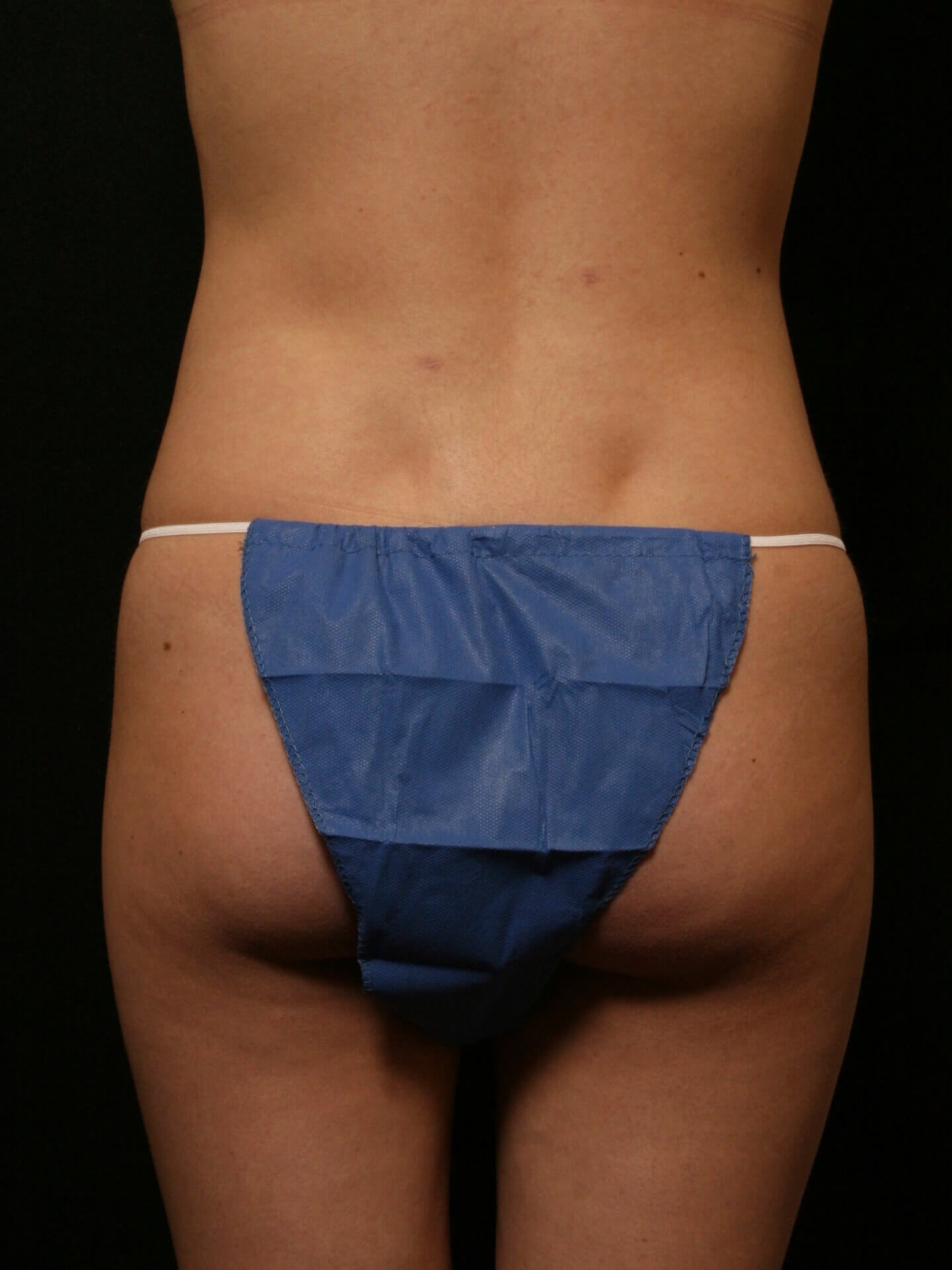 Liposuction Before and After After