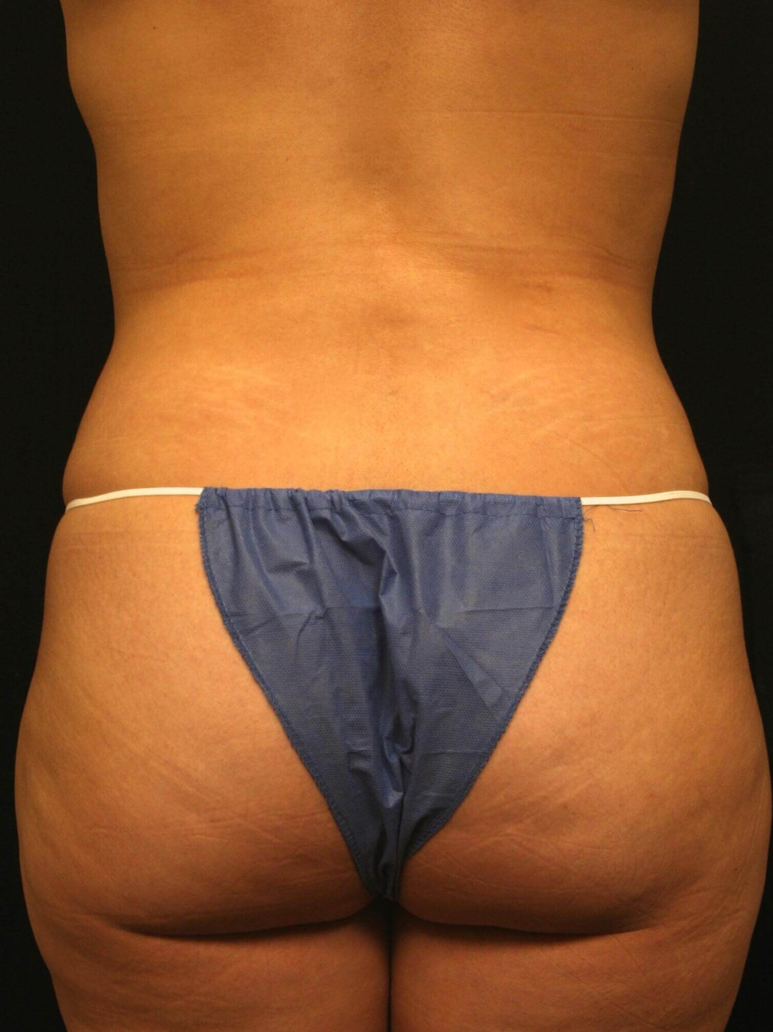 Liposuction Before and After After