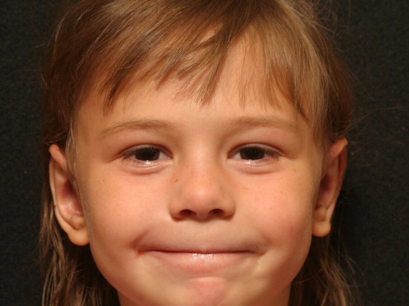 Otoplasty Before and After After