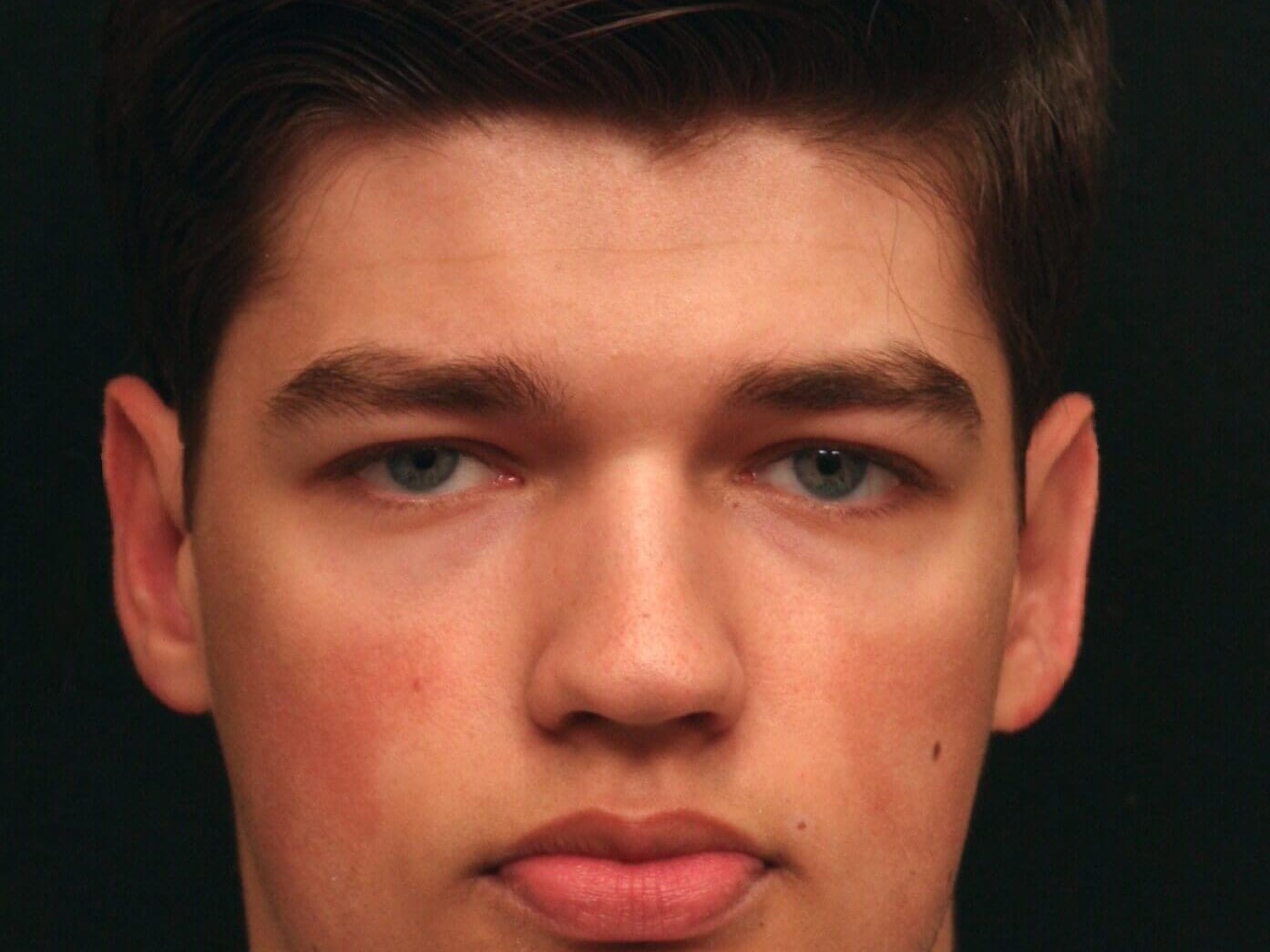 Otoplasty Before and After After