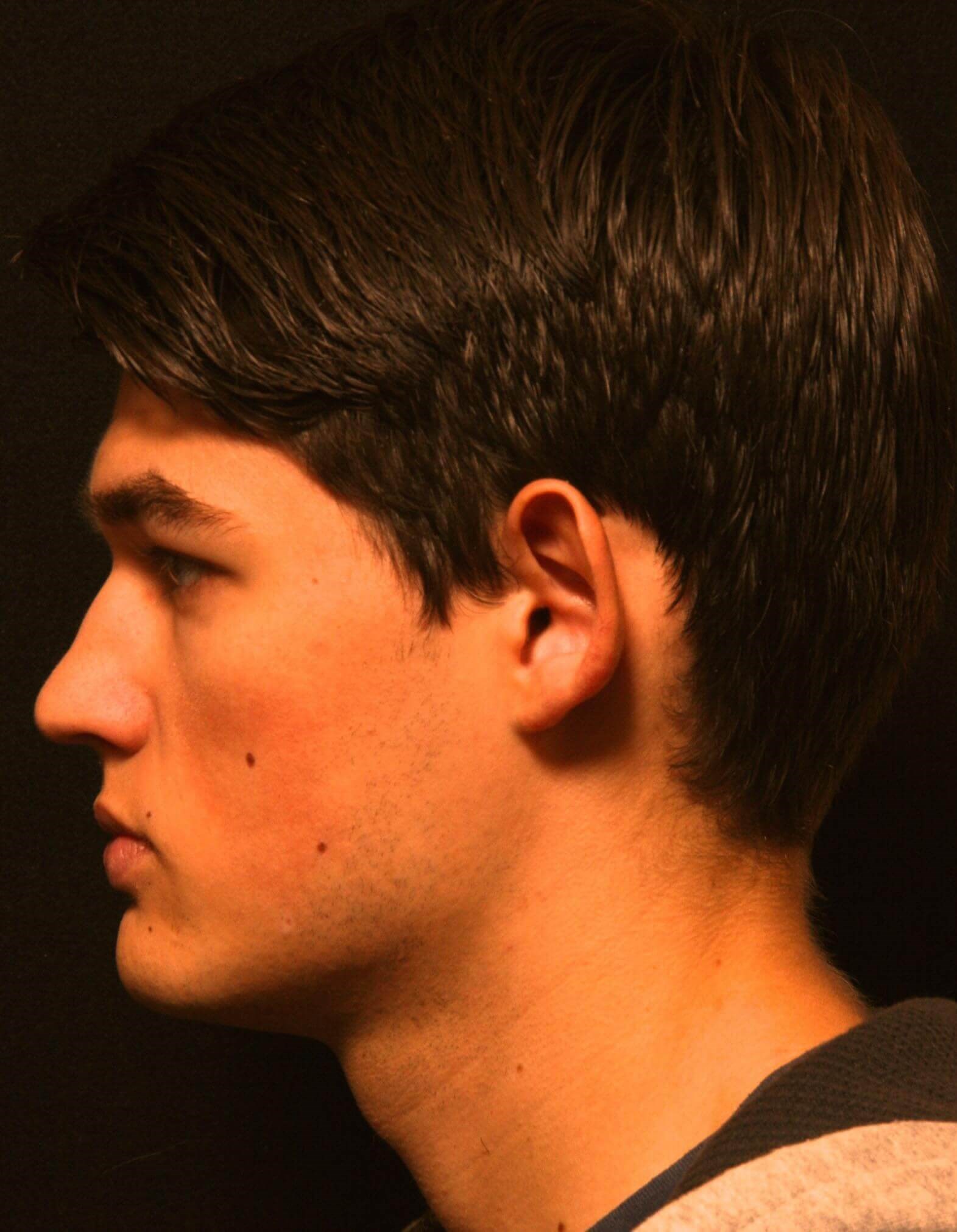 Otoplasty Before and After Before