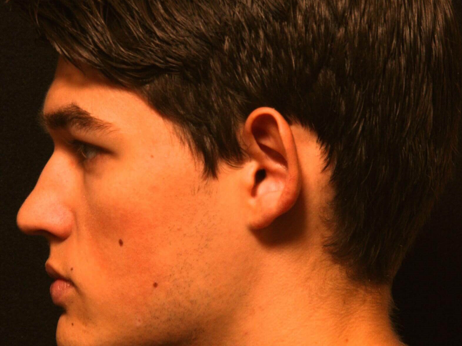 Otoplasty Before and After Before