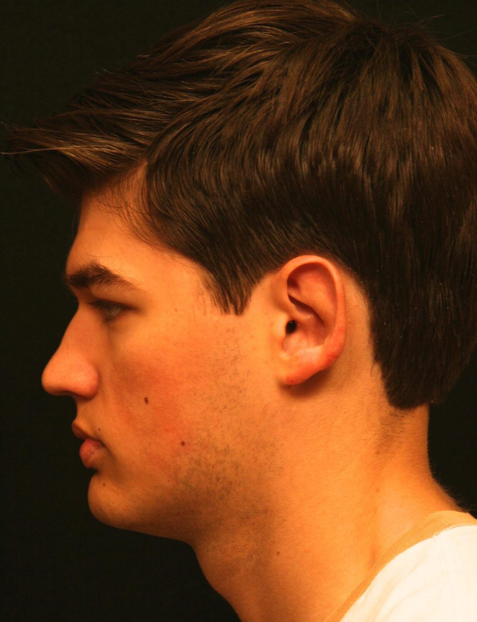 Otoplasty Before and After After