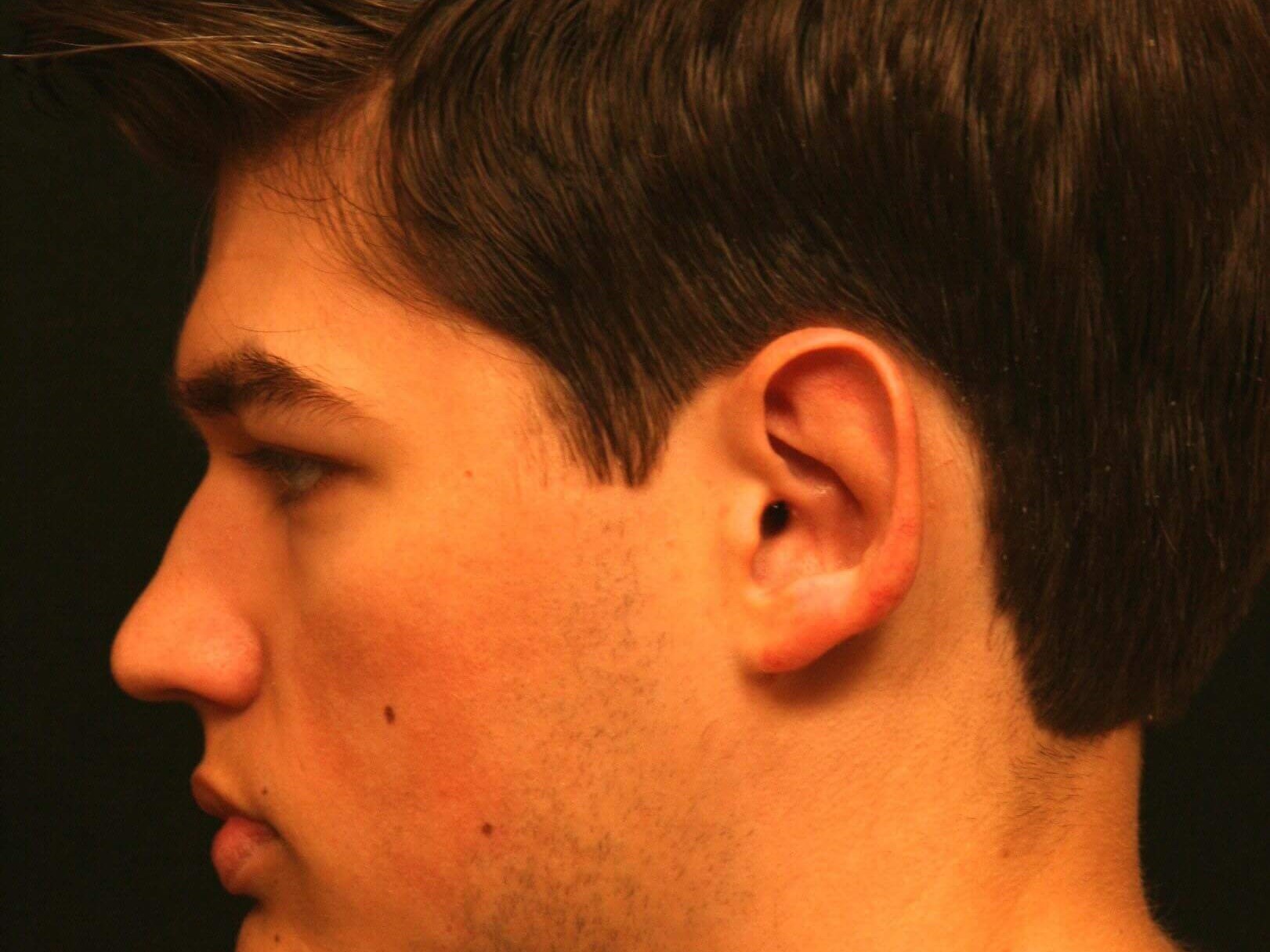 Otoplasty Before and After After