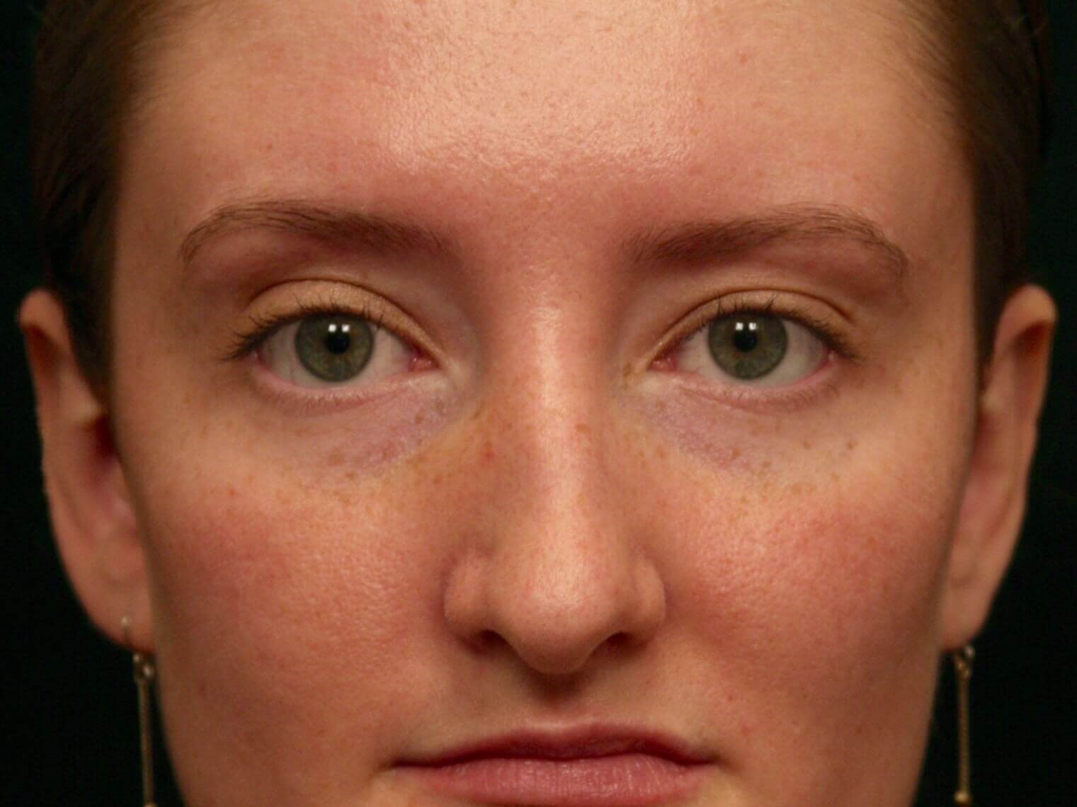 Otoplasty Before and After After