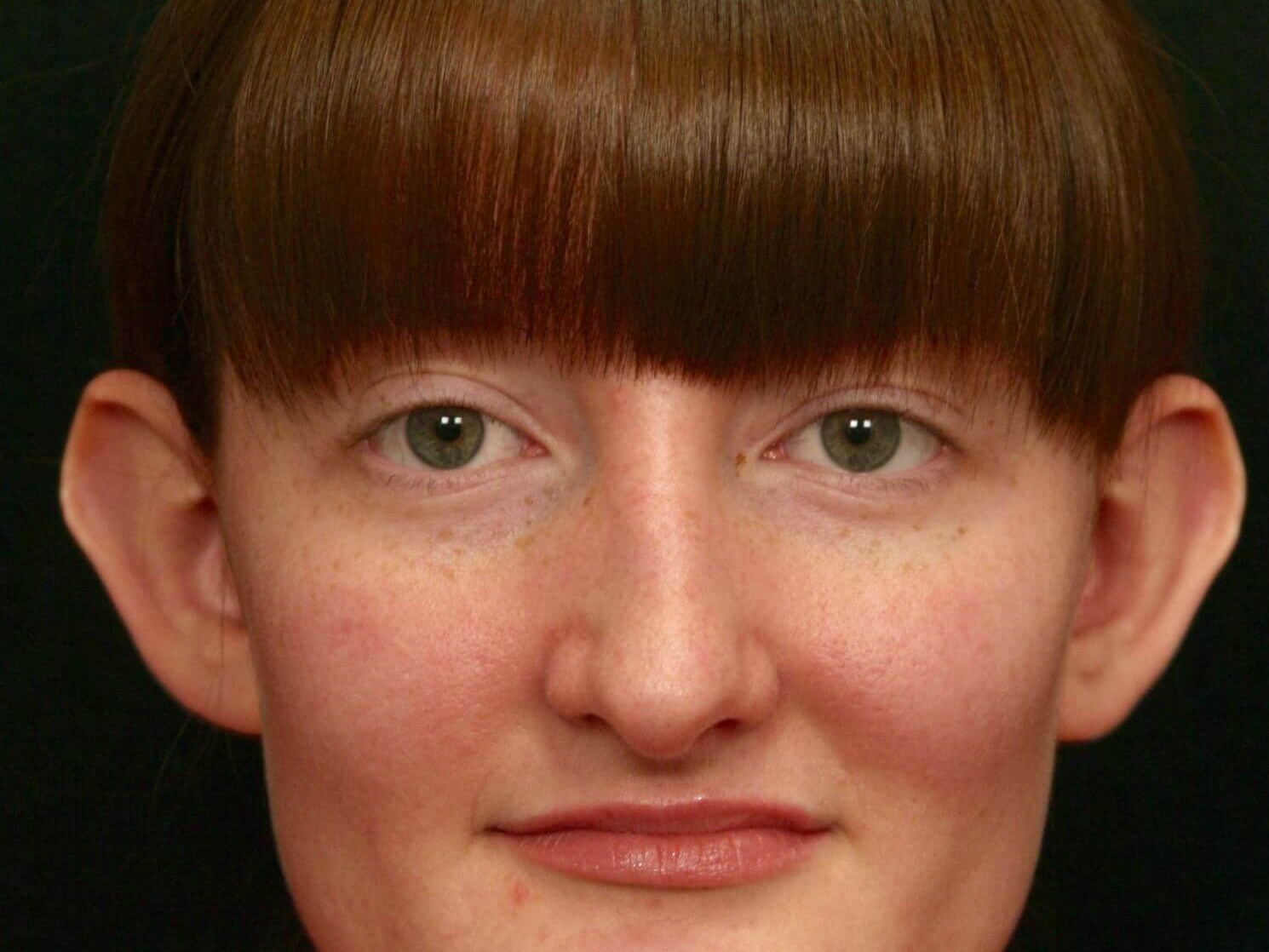 Otoplasty Before and After Before