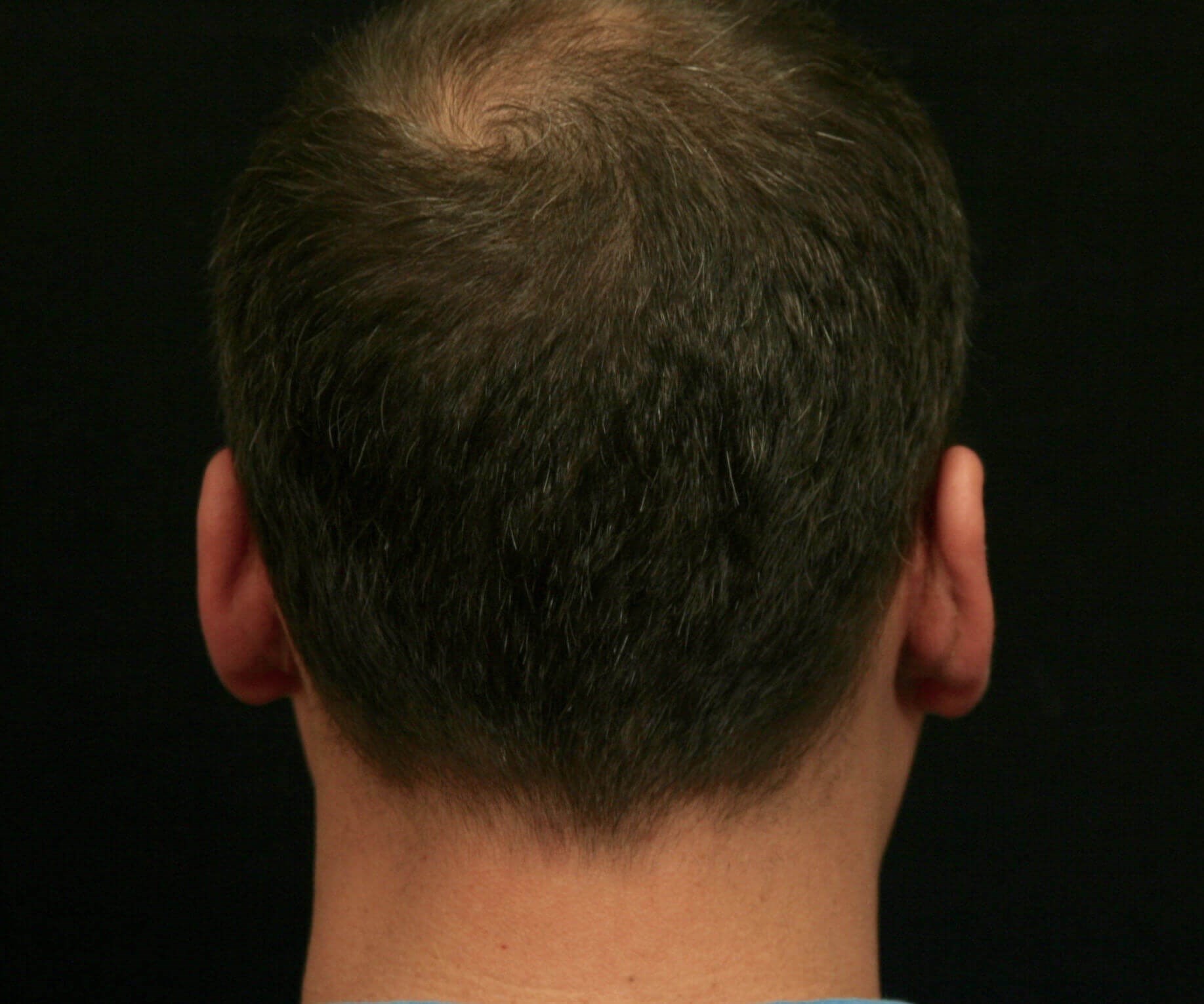 Otoplasty Before and After After