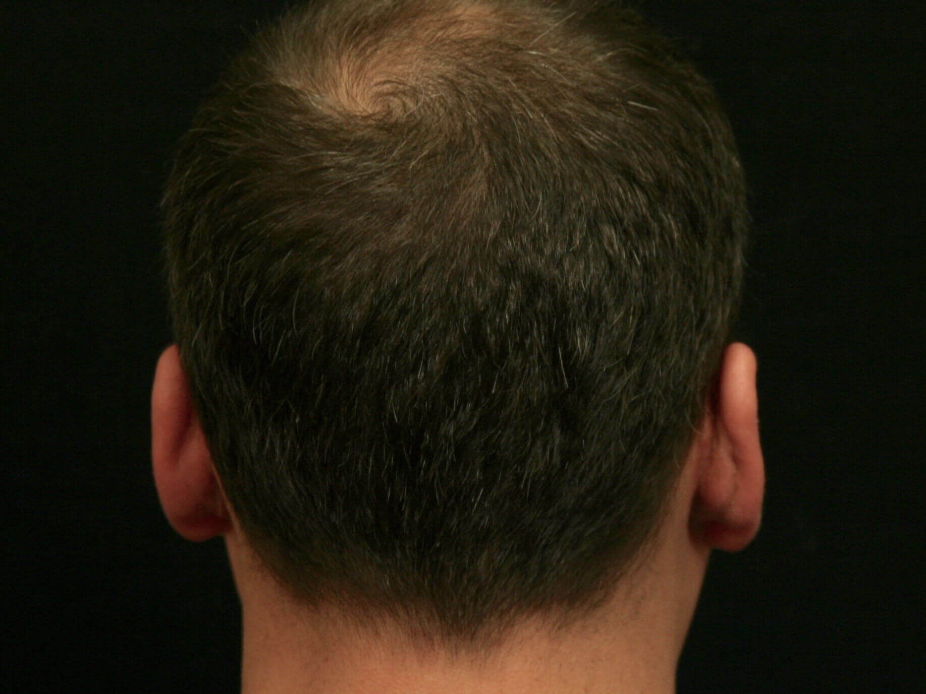 Otoplasty Before and After After