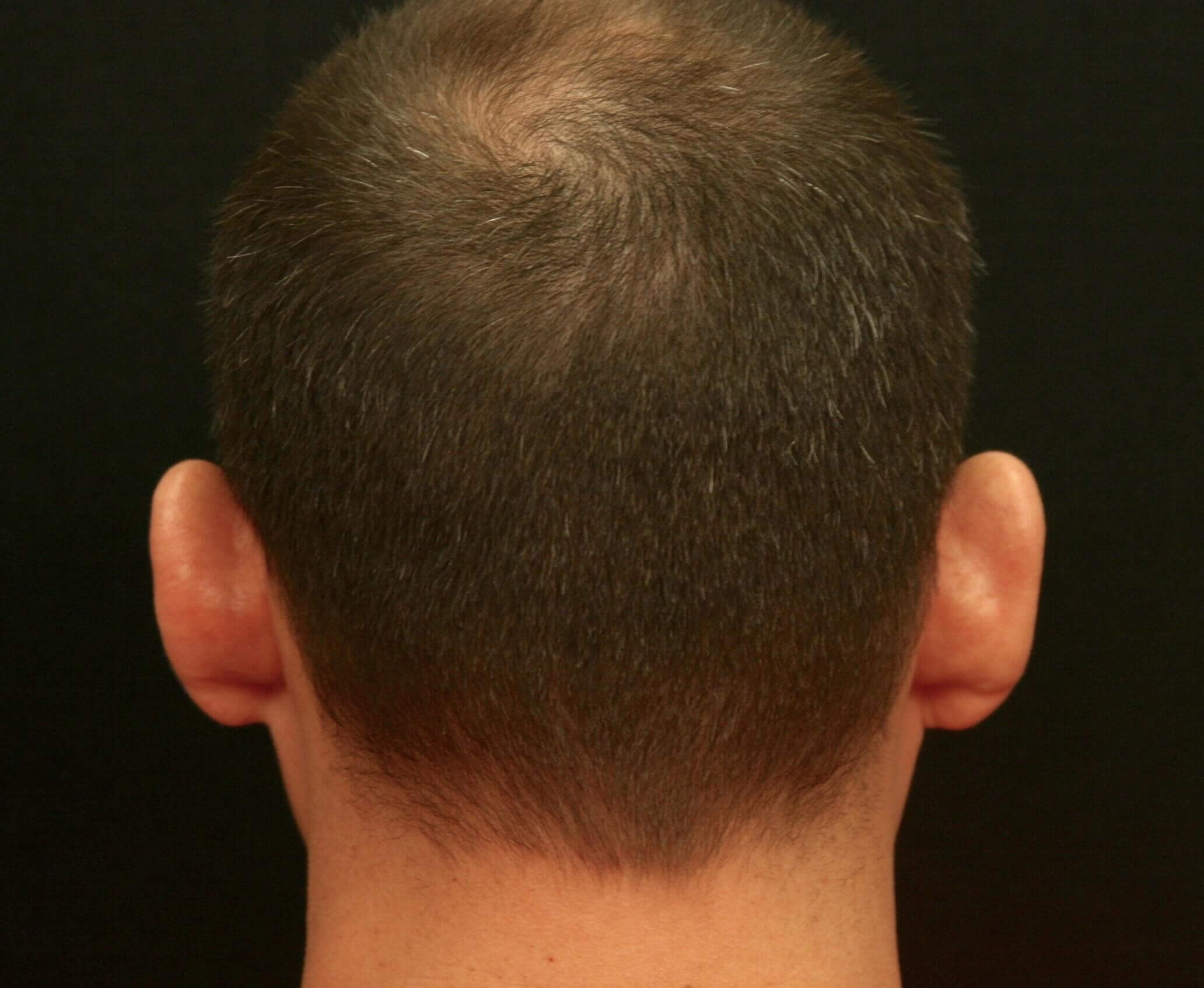 Otoplasty Before and After Before