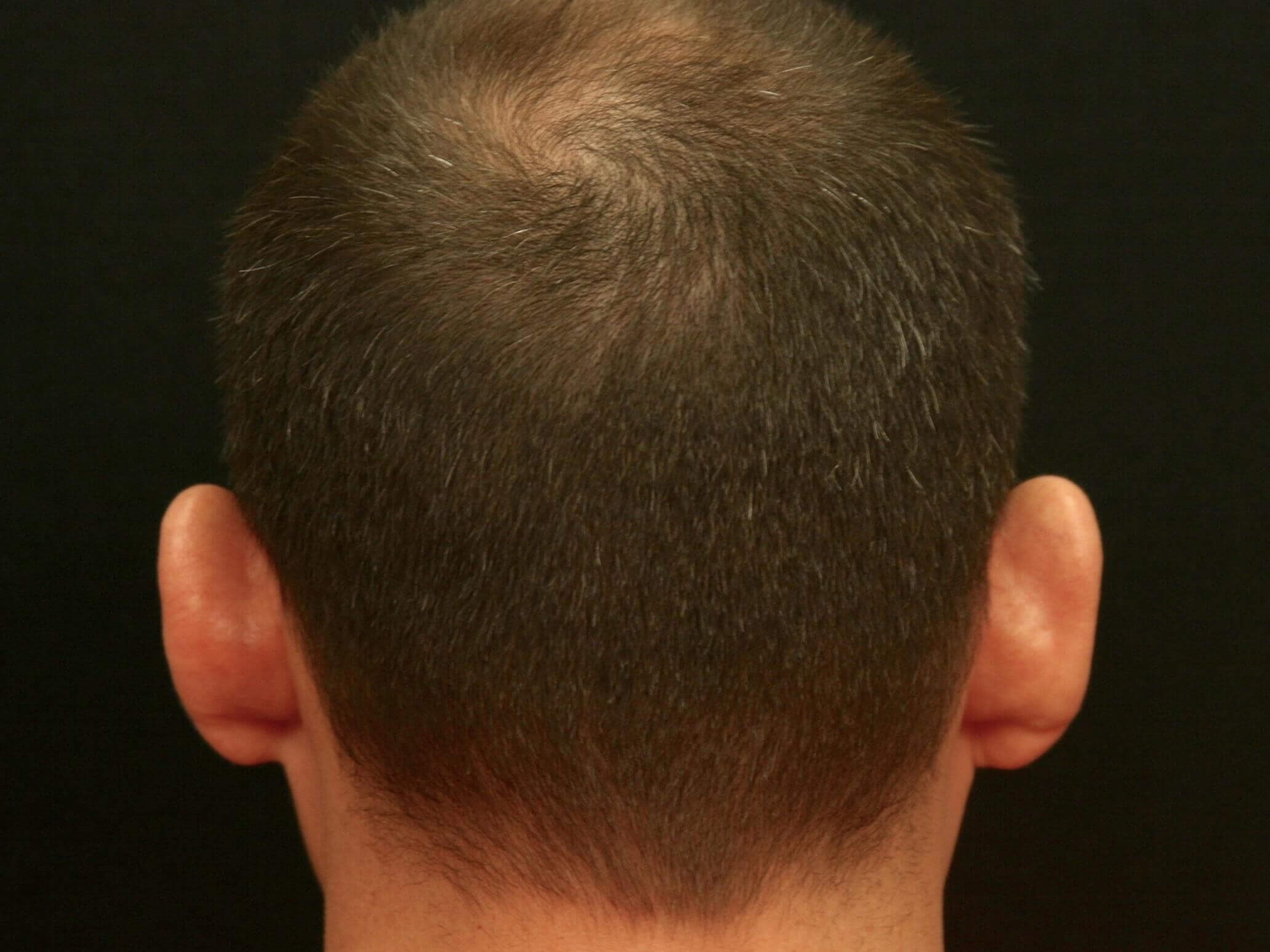 Otoplasty Before and After Before