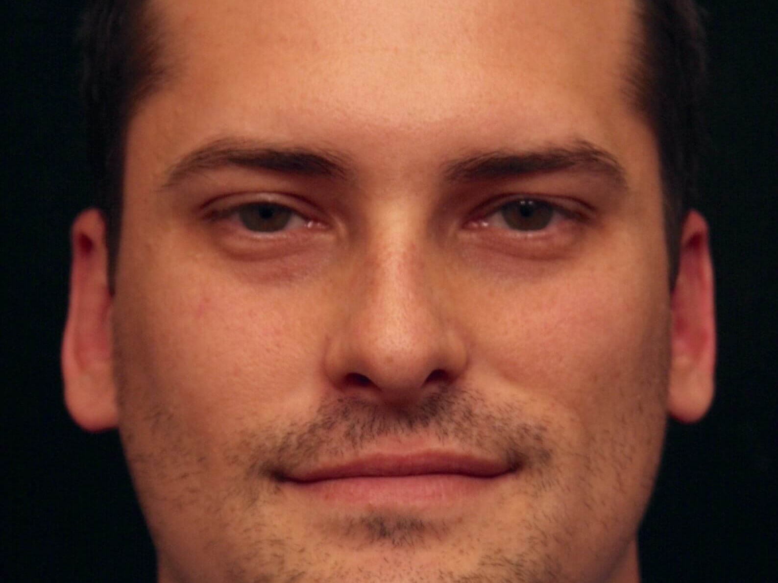 Otoplasty Before and After After