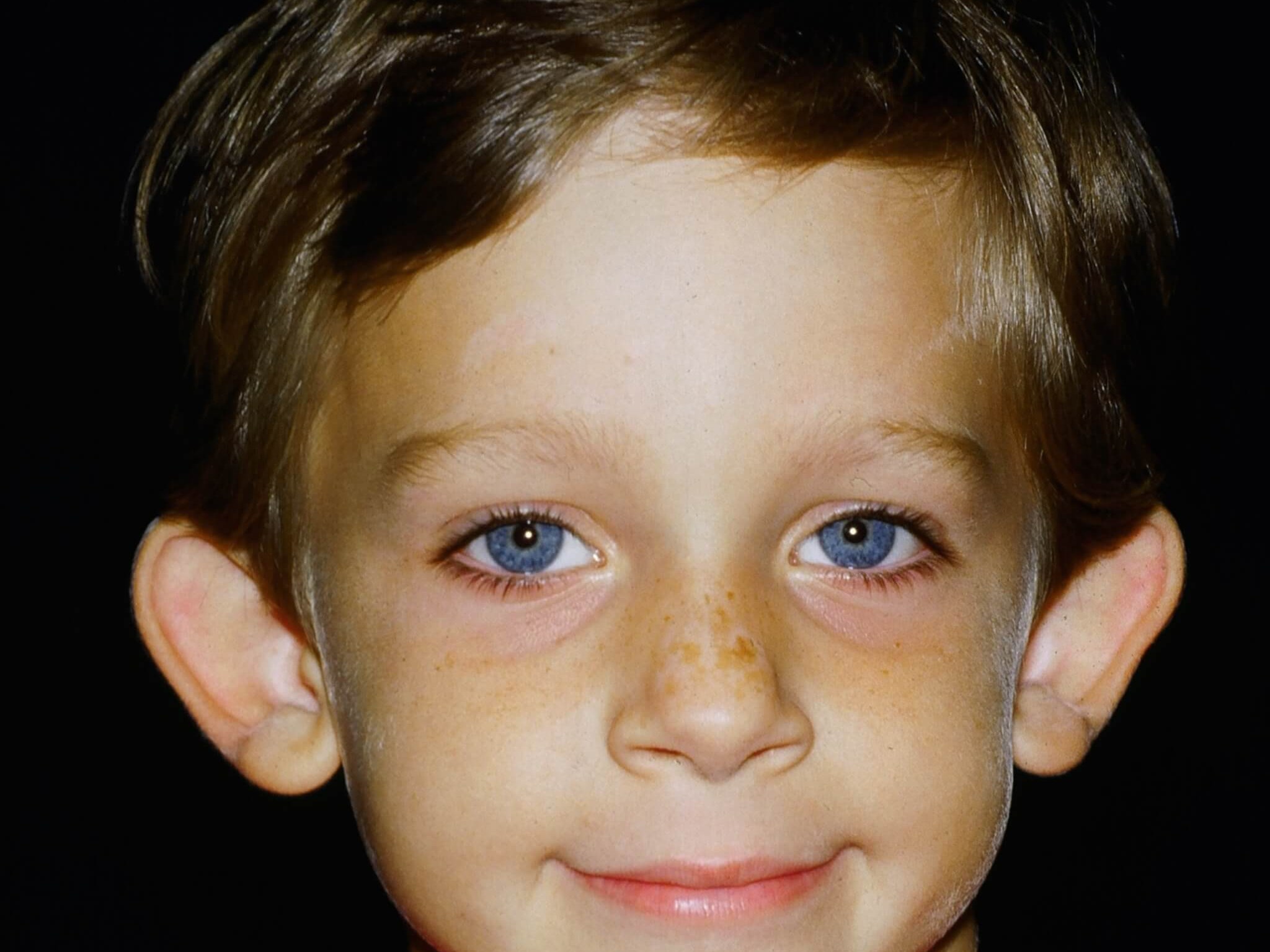 Otoplasty Before and After Before