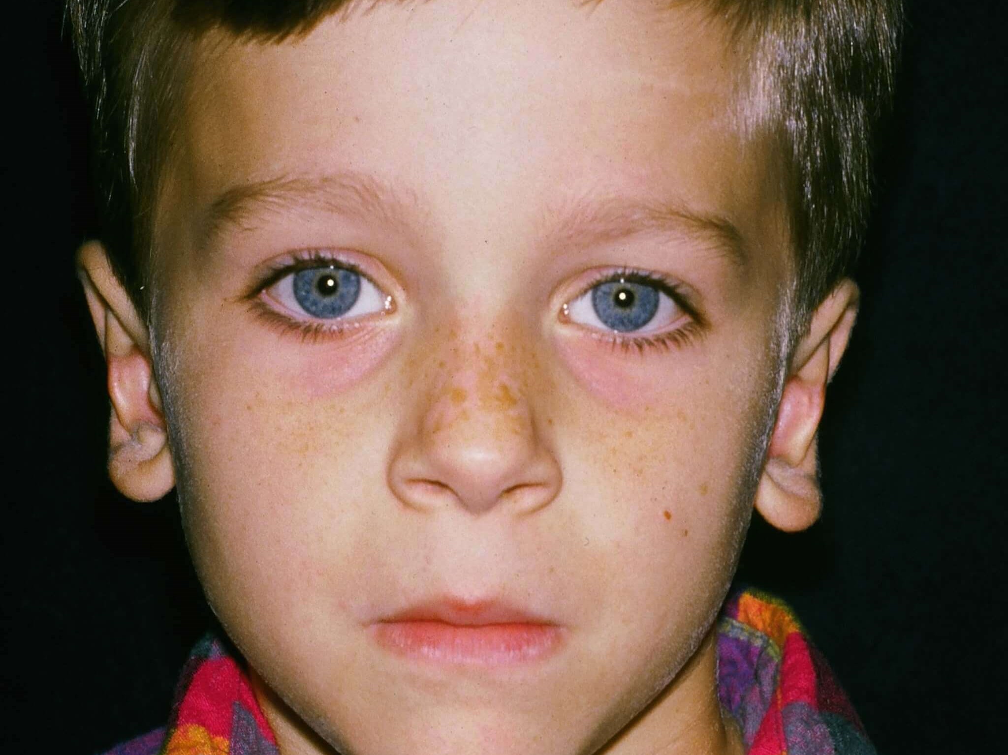 Otoplasty Before and After After