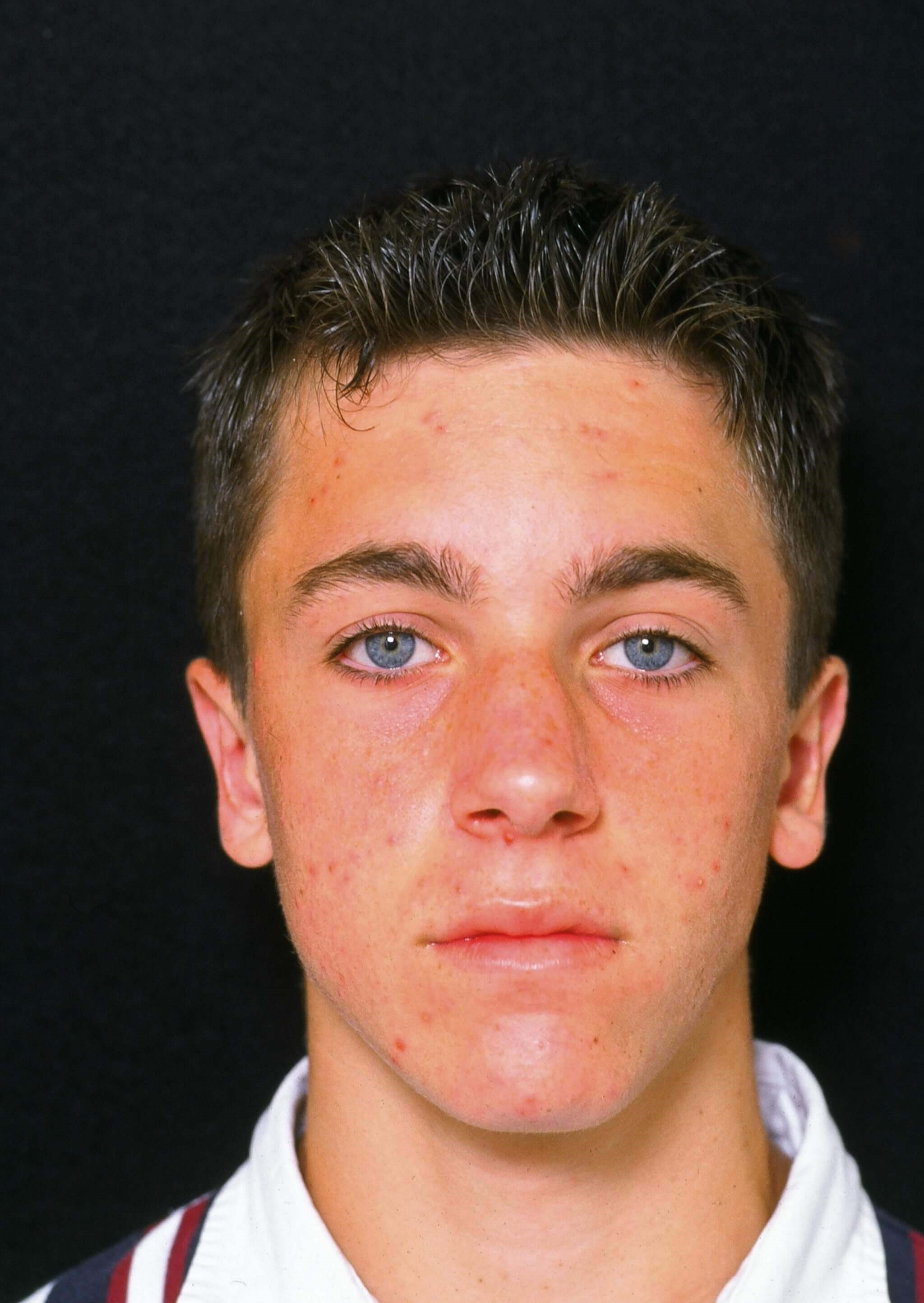 Otoplasty Before and After After