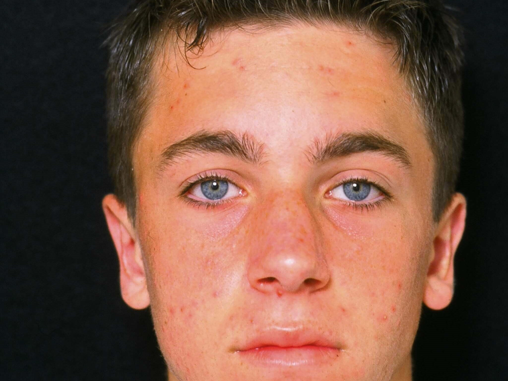 Otoplasty Before and After After