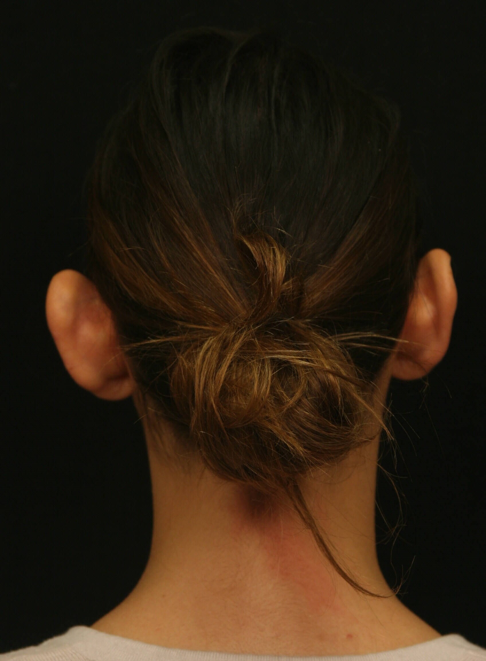 Otoplasty Before and After Before