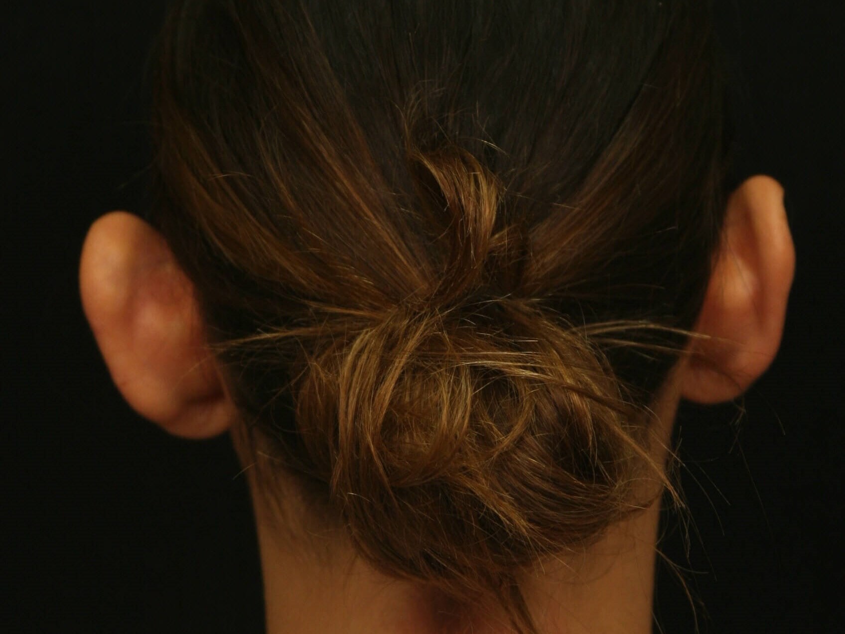 Otoplasty Before and After Before