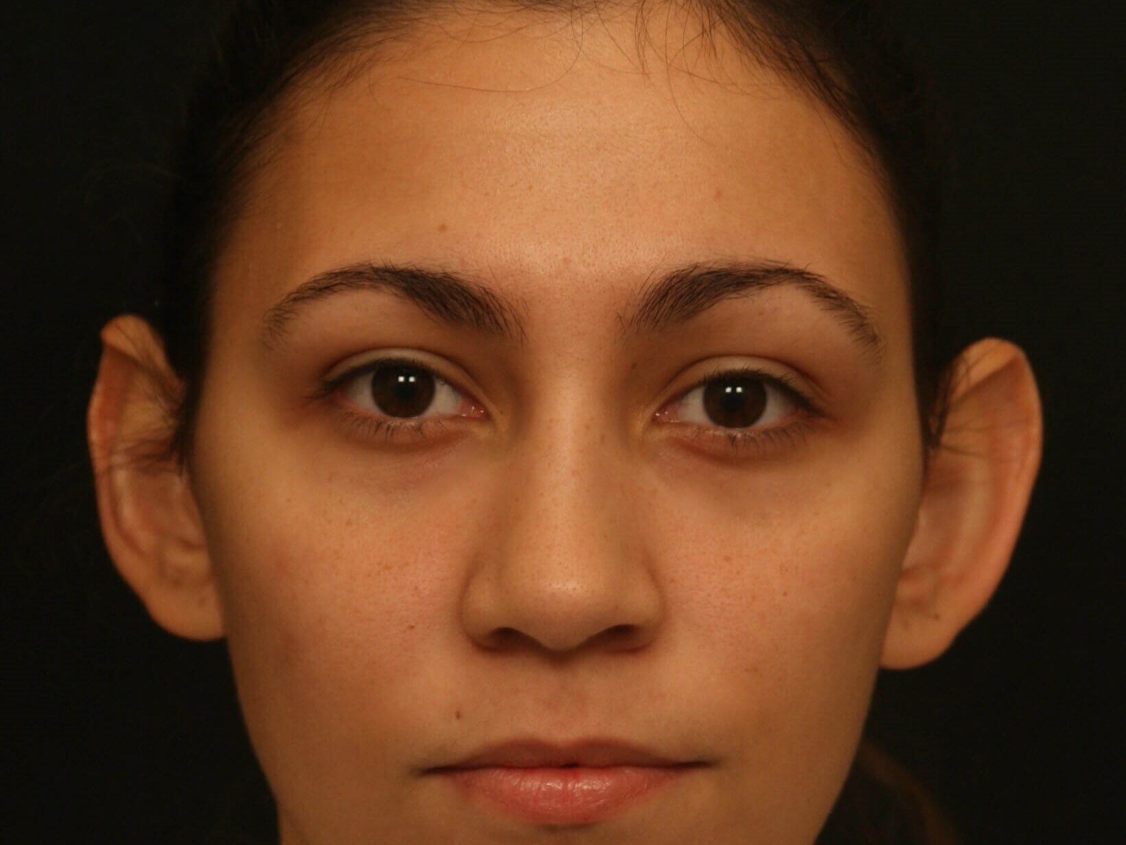 Otoplasty Before and After Before