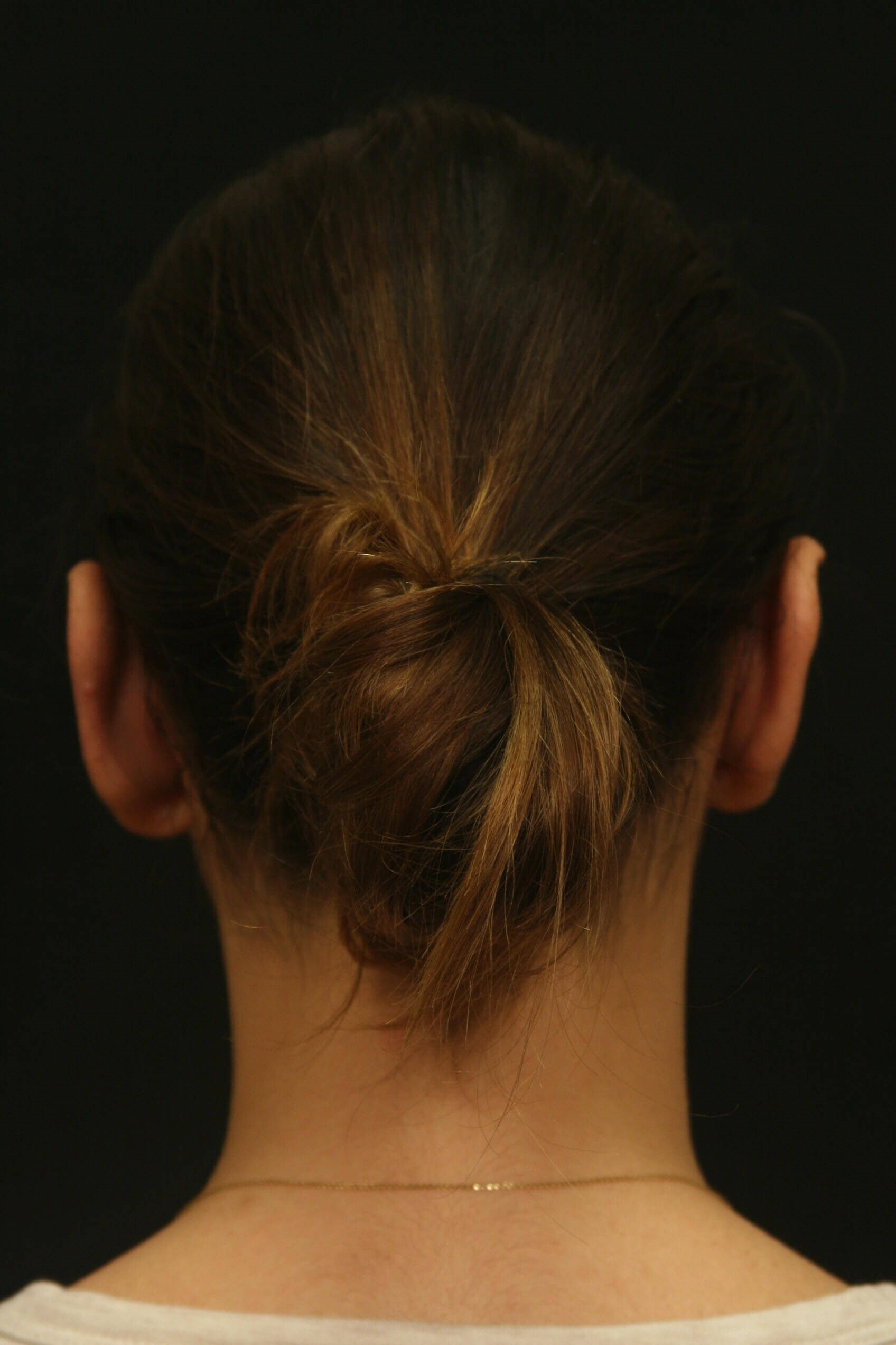 Otoplasty Before and After After