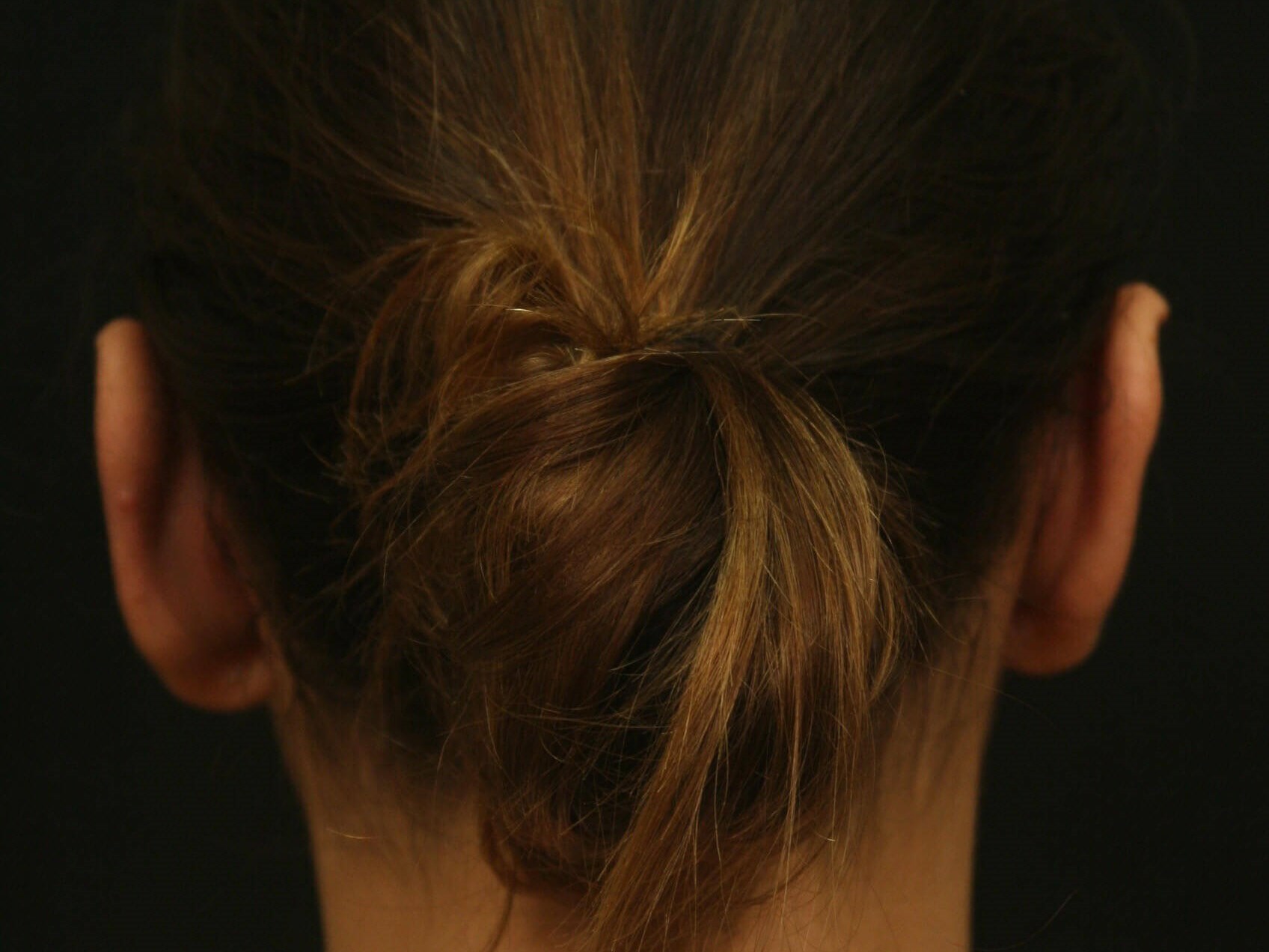 Otoplasty Before and After After