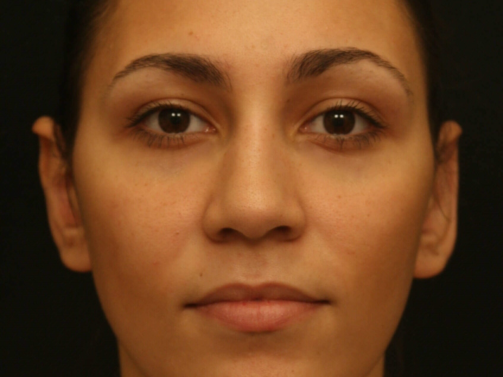 Otoplasty Before and After After