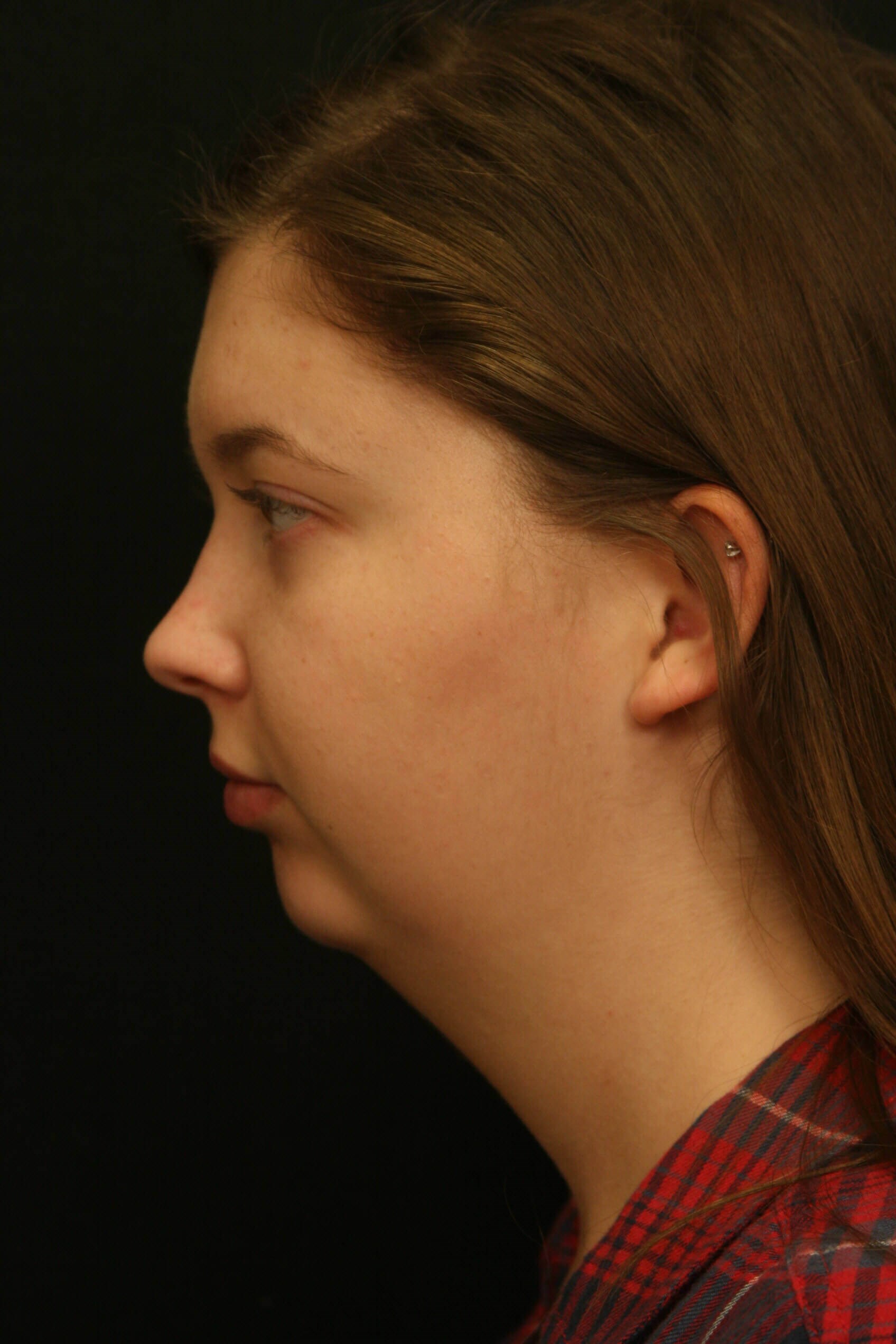 Chin Implant Before and After Before