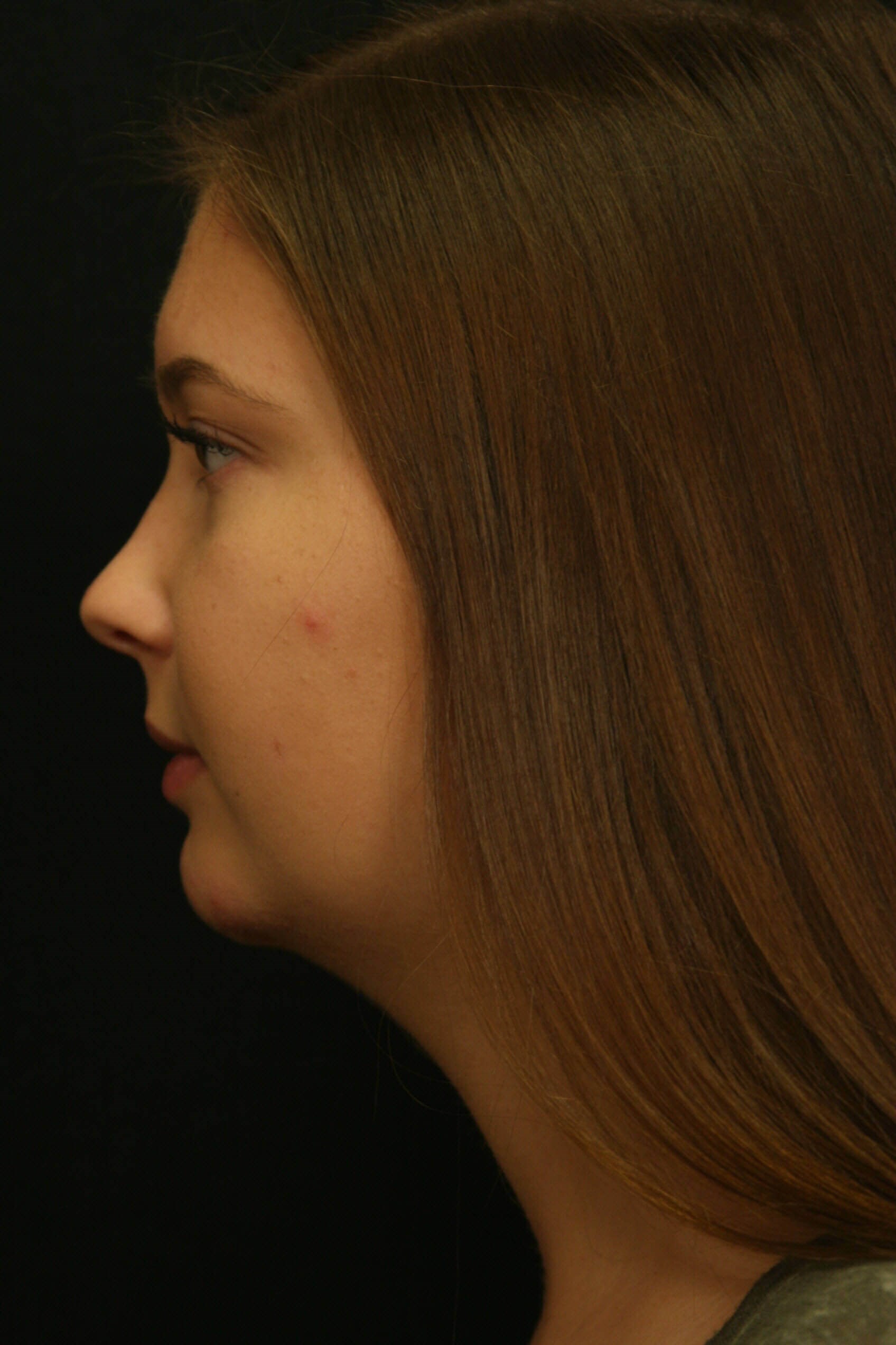 Chin Implant Before and After After