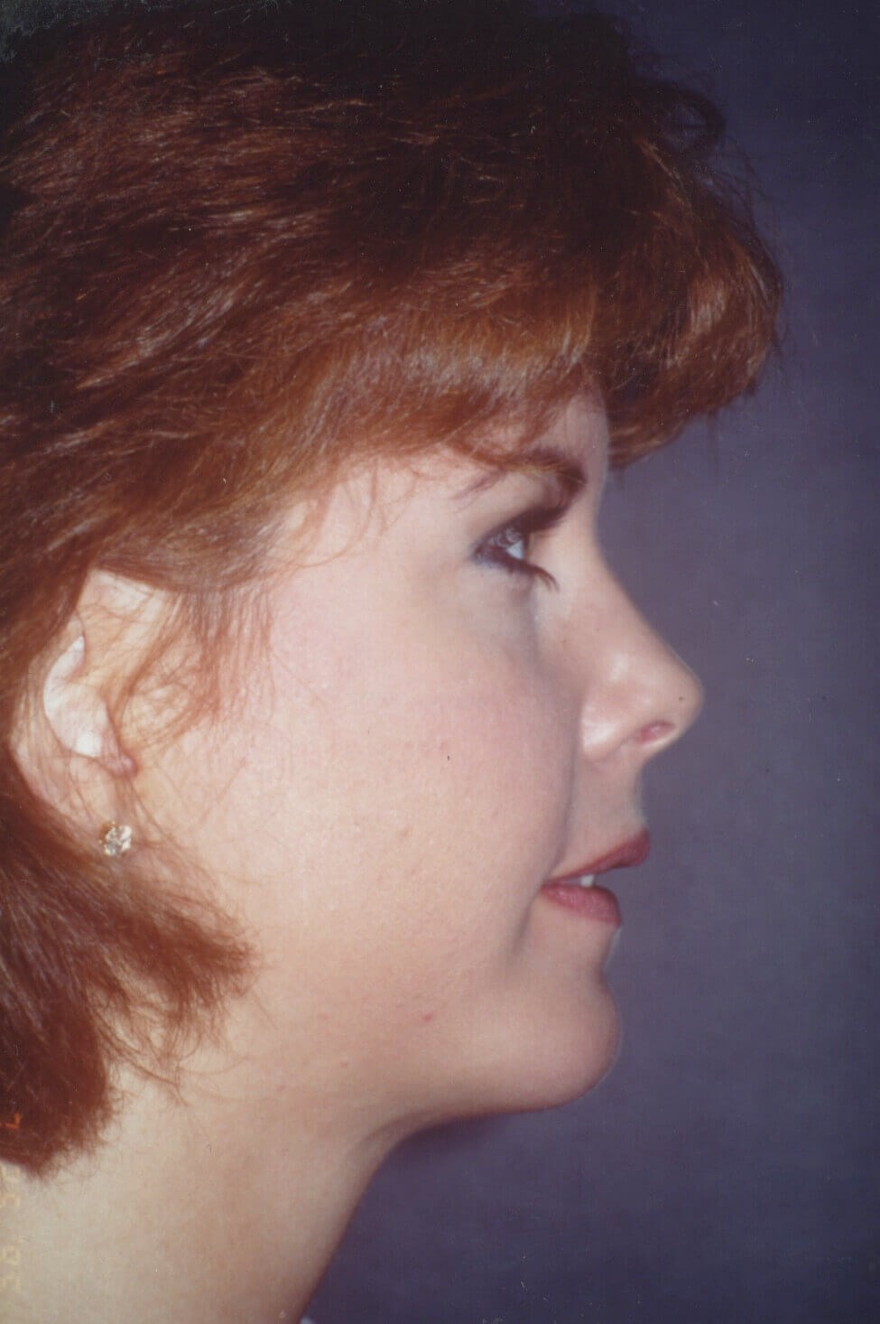 Chin Implant Before and After After