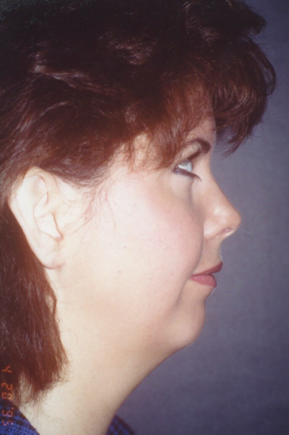 Chin Implant Before and After Before