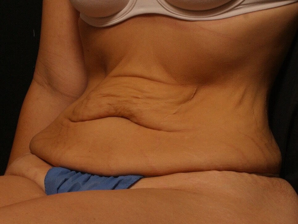 Mid-Body Lift Before and After Before