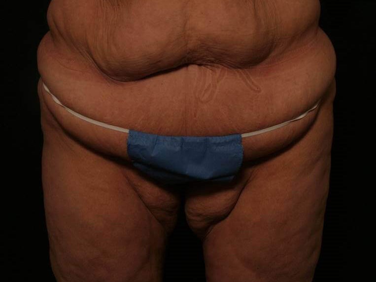 Mid-Body Lift Before and After Before