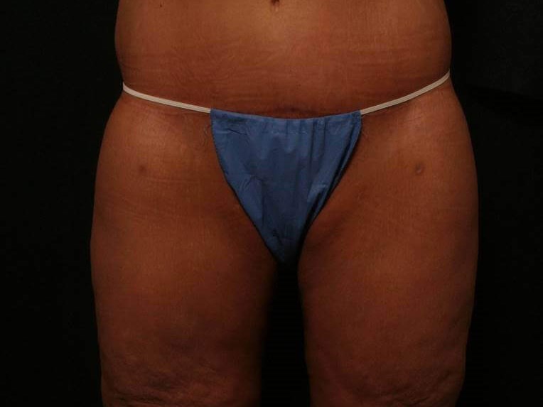 Mid-Body Lift Before and After After