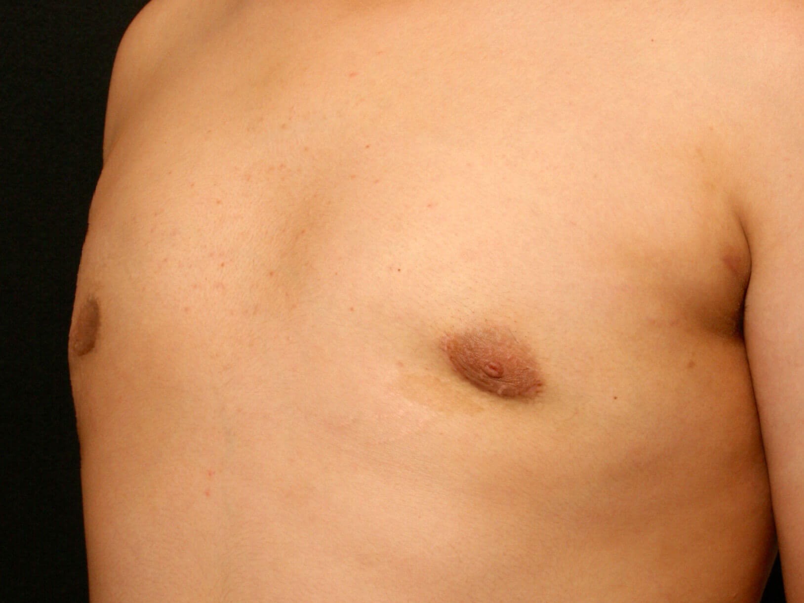 Gynecomastia Before and After After
