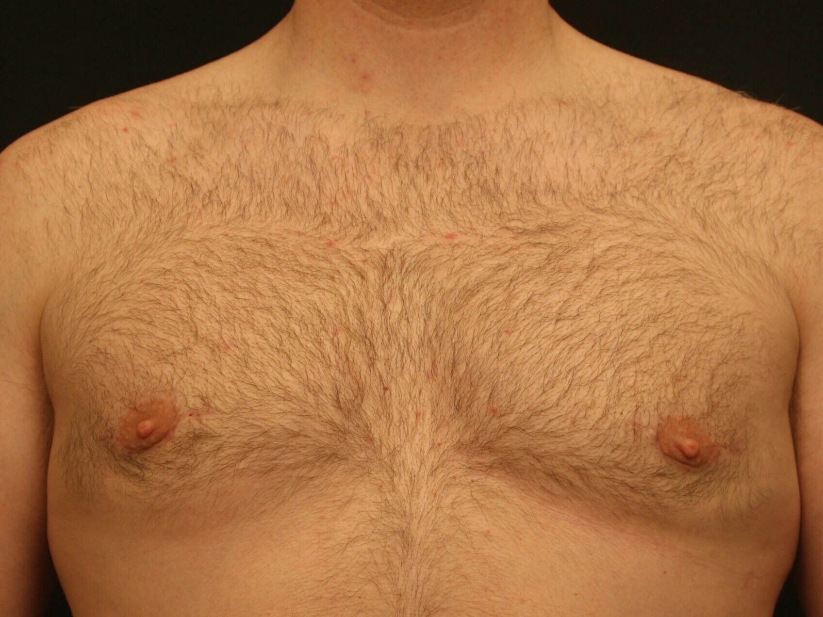 Gynecomastia Before and After After