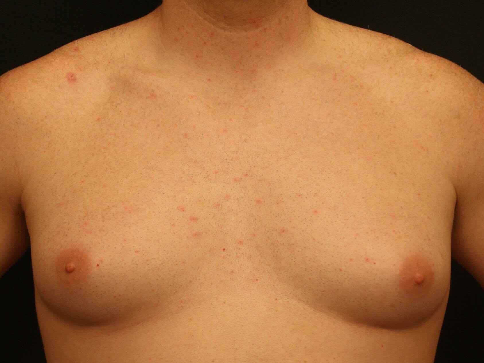 Gynecomastia Before and After Before