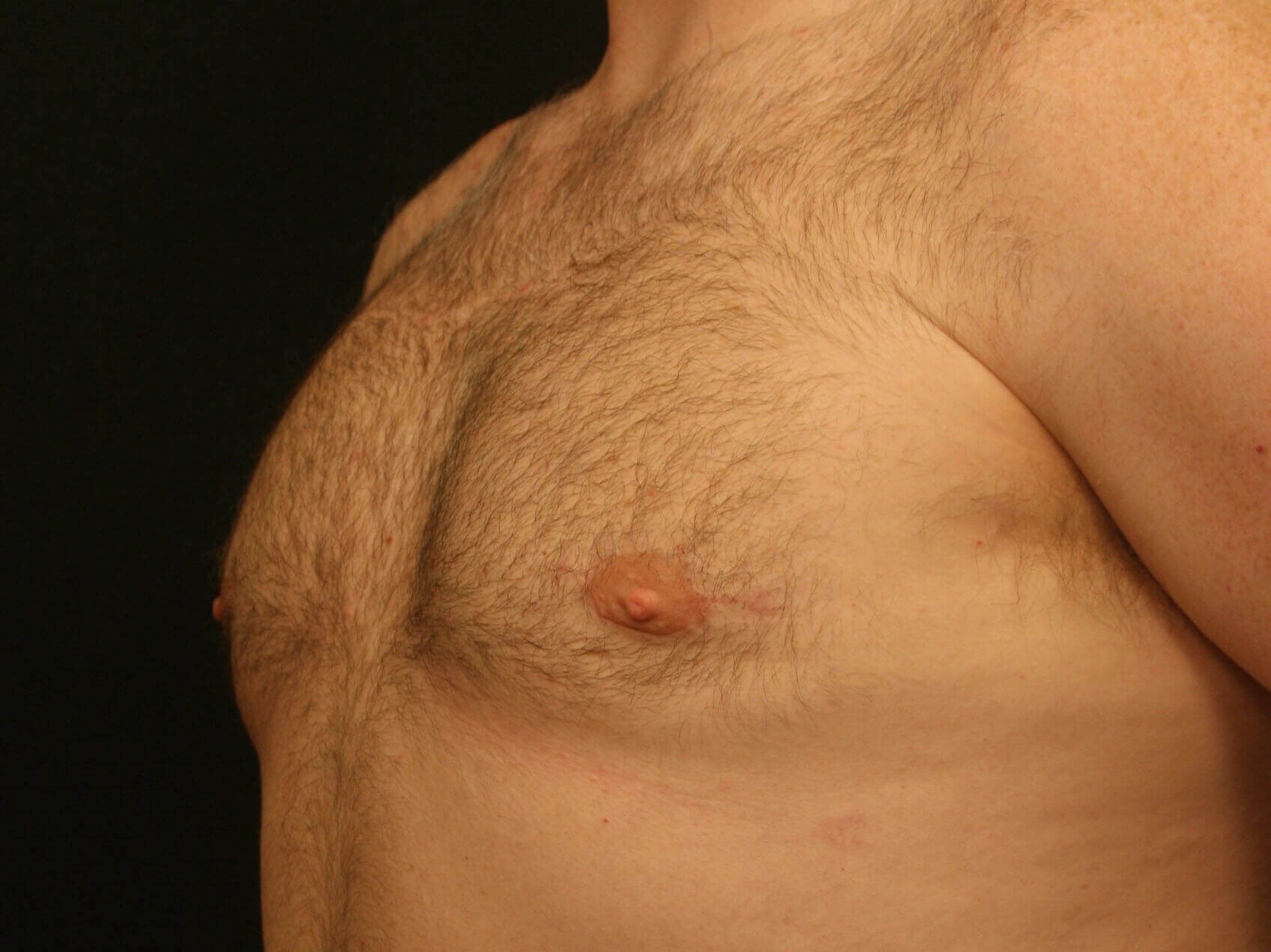 Gynecomastia Before and After After