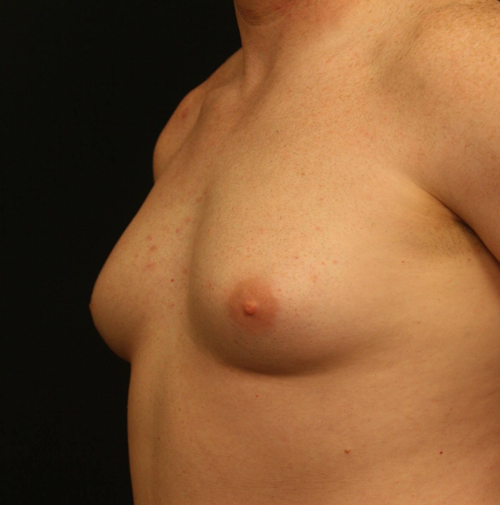 Gynecomastia Before and After Before