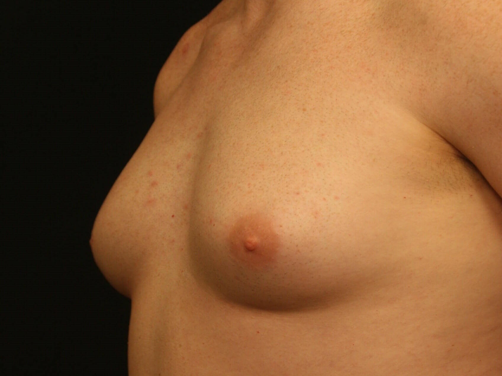 Gynecomastia Before and After Before