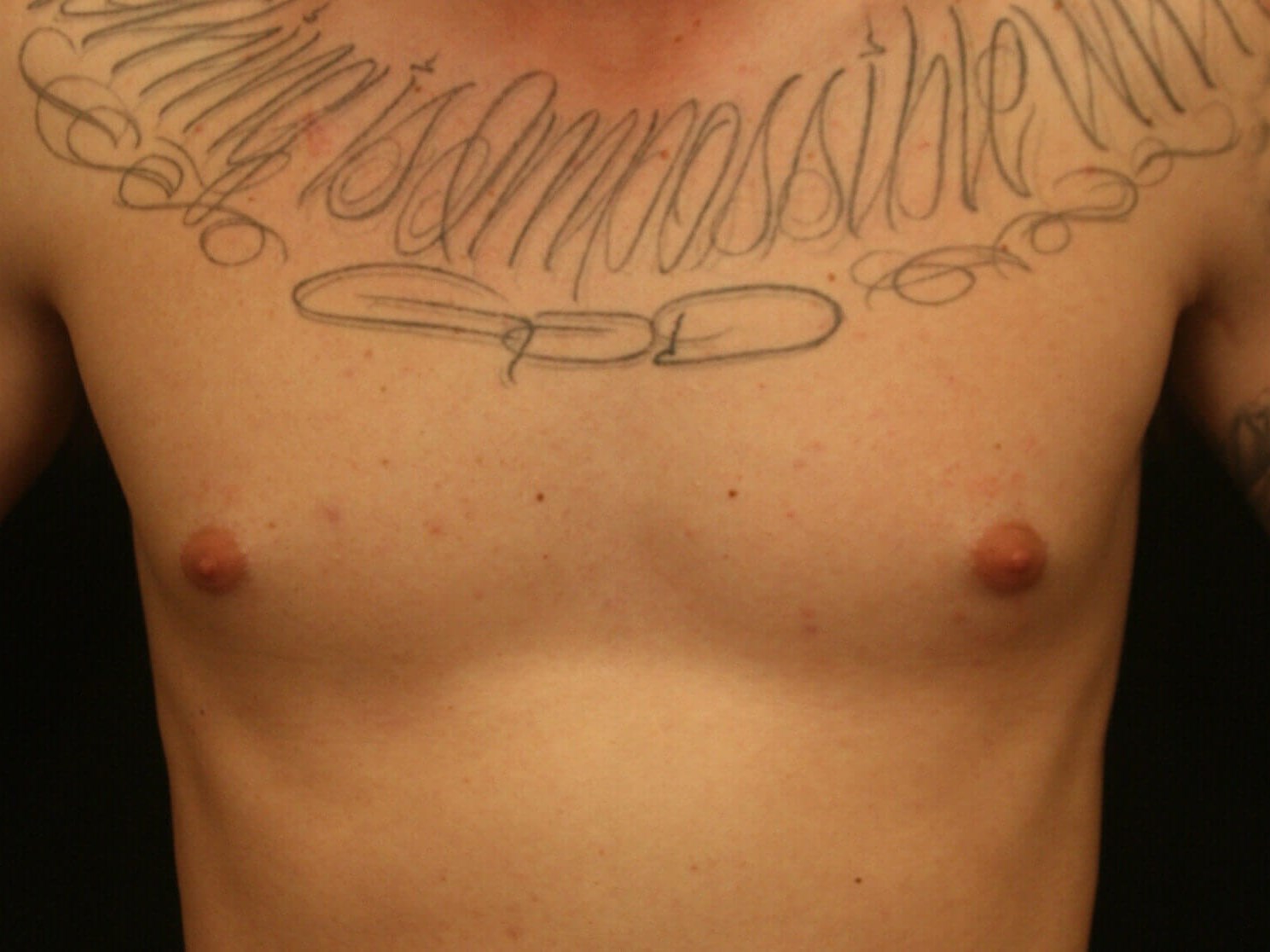 Gynecomastia Before and After Before