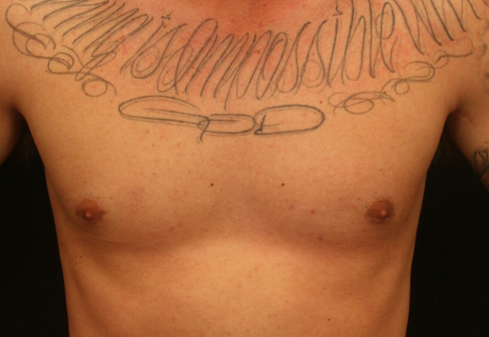 Gynecomastia Before and After After